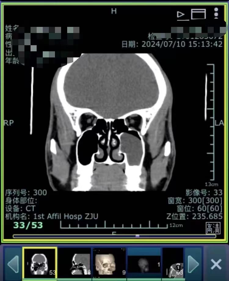 左侧上颌窦潴留囊肿伴继发慢性炎症倾向